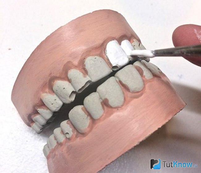 Окрашивание цементных зубов в белый цвет