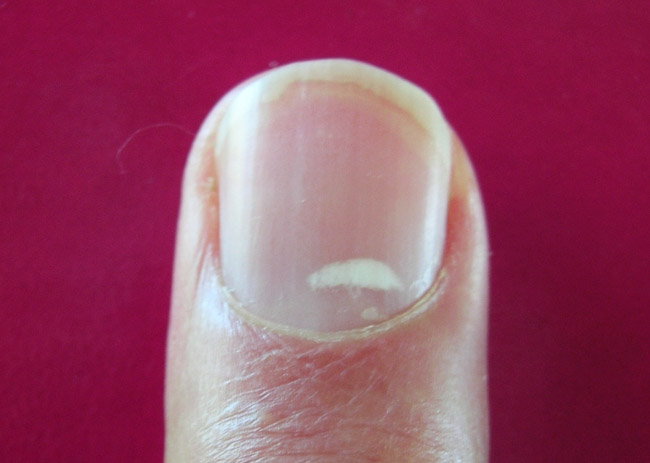 Белые пятна на ногтях рук