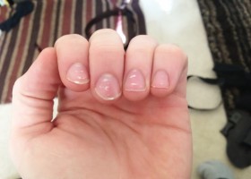 Белые пятна на ногтях рук: причины и как избавится