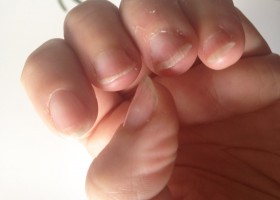 Ломкие ногти: причина, лечение и уход