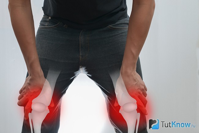 Боль в коленях при артрите