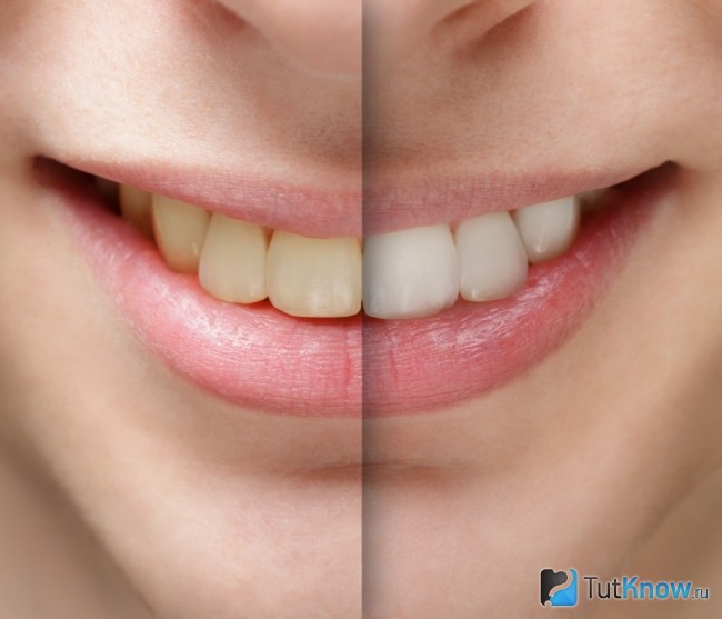 До и после отбеливания зубов маслом чайного дерева