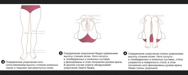 Длина ног. Лечебная физкультура при укорочении ноги. Разная длина ног у взрослых. Упражнения при разной длине ног. Разница в длине ног.