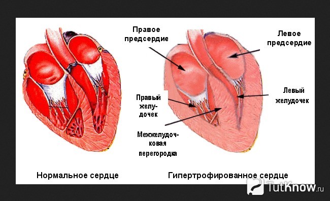 Стенки левого предсердия