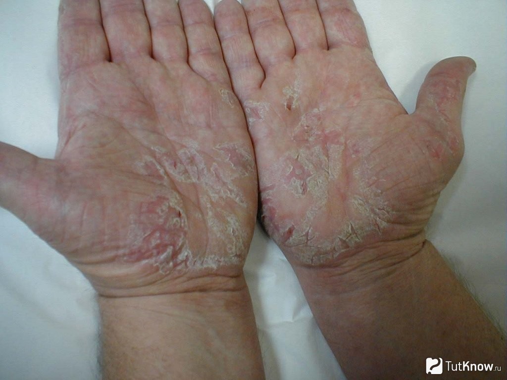 Зимой сохнет и трескается кожа рук: дерматолог посоветовал, как за ней ухаживать