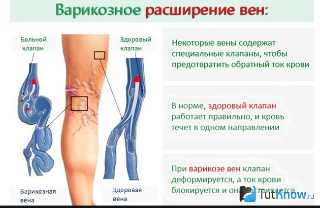 Справка о варикозном расширении вен
