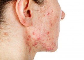 Как лечить себорею на лице