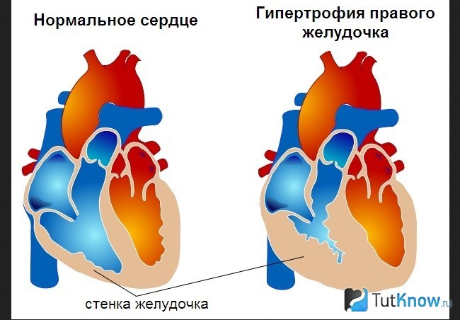Сравнение здорового и гипертрофированного сердца