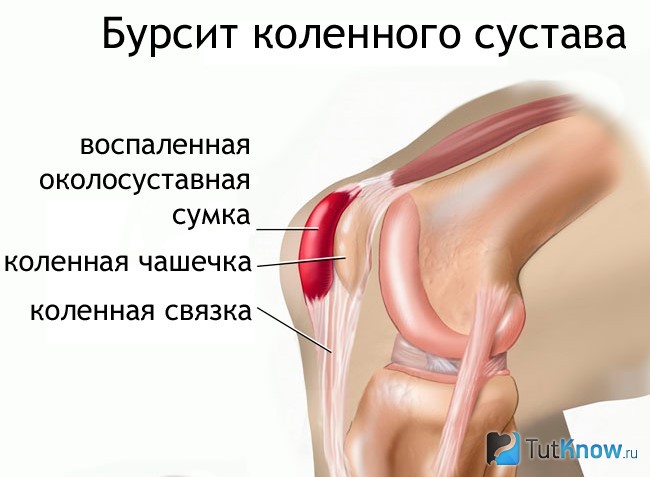 Бурсит коленного сустава