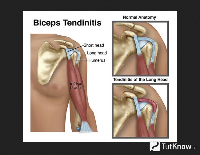 Тендинит бицепса