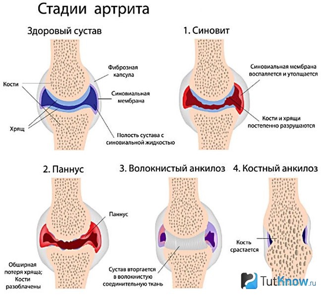 Стадии артрита