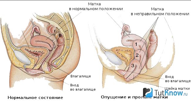 Сравнение нормы и опущенной матки