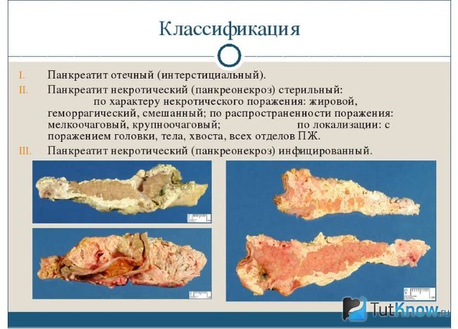 Формы панкреатита