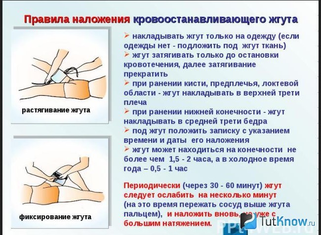 Правила фиксации жгута