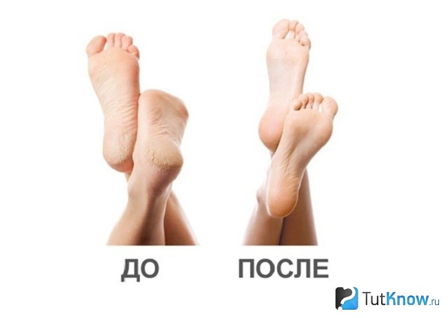 Пятки до и после аквапилинга