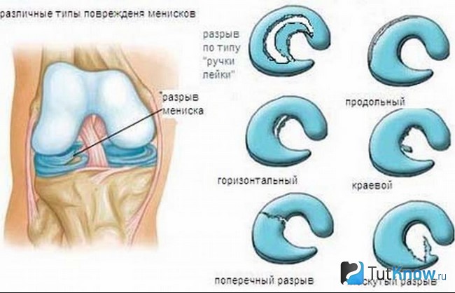 Типы повреждения мениска
