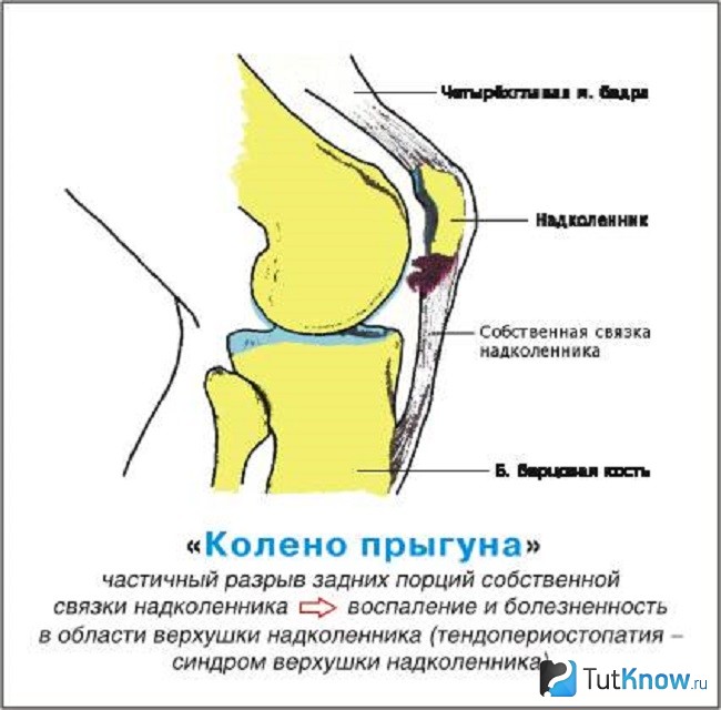 Колено прыгуна