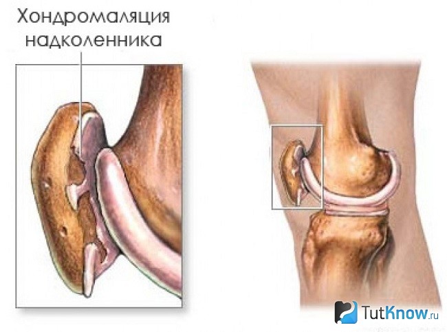 Хондромаляция надколленика