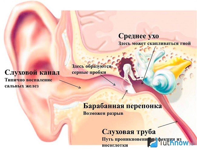 Схема образования пробки в ушах