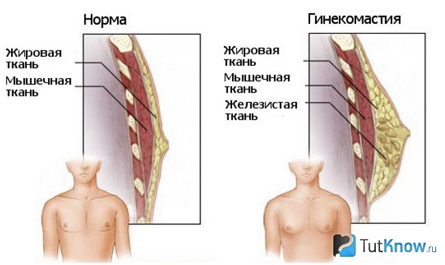 Схематическое сравнение нормы и развития гинекомастии