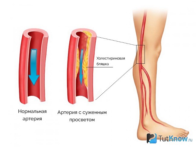 Заболевания сосудов