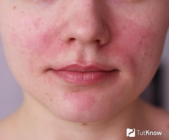Аллергические пятна на лице