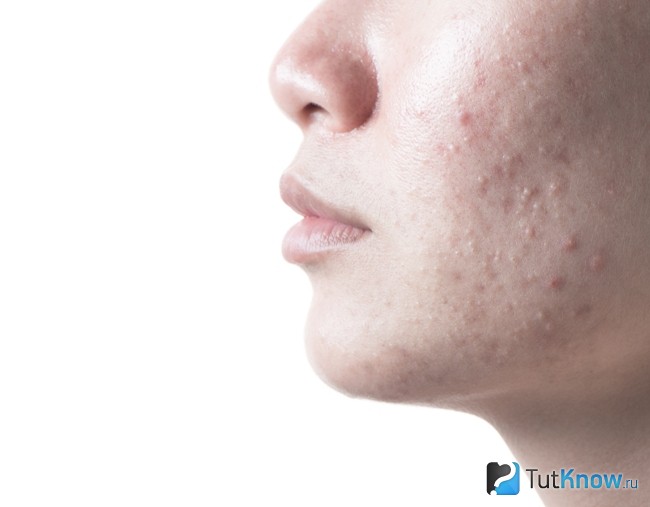 Аллергия как противопоказание к маскам с календулой
