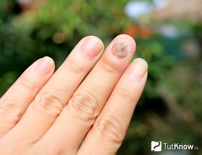 Повреждение ногтей как противопоказание для ванночек