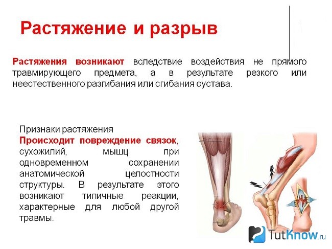 Рвутся связки чего не хватает в организме. Смотреть фото Рвутся связки чего не хватает в организме. Смотреть картинку Рвутся связки чего не хватает в организме. Картинка про Рвутся связки чего не хватает в организме. Фото Рвутся связки чего не хватает в организме