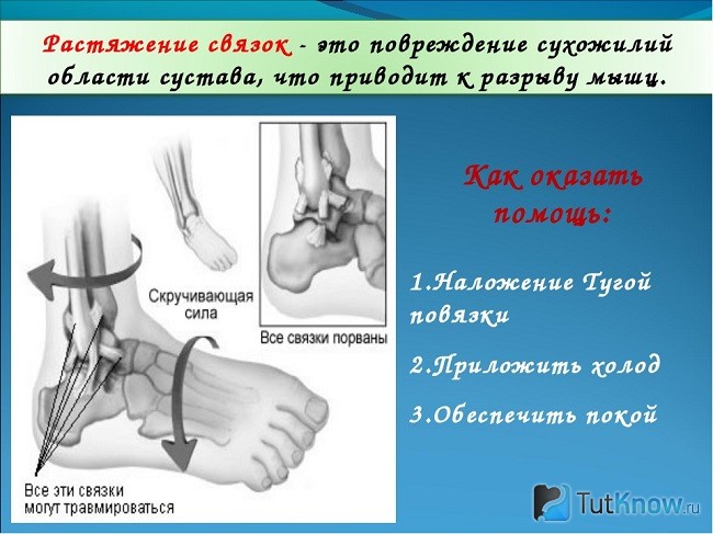 Рвутся связки чего не хватает в организме. Смотреть фото Рвутся связки чего не хватает в организме. Смотреть картинку Рвутся связки чего не хватает в организме. Картинка про Рвутся связки чего не хватает в организме. Фото Рвутся связки чего не хватает в организме