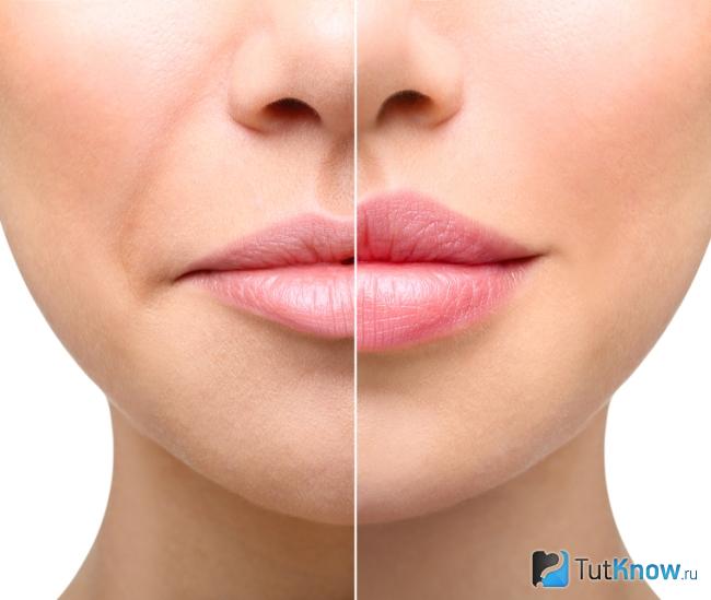 Увеличение губ биогелем: до и после