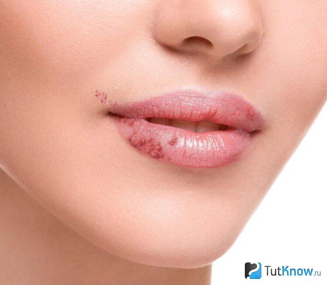 Травмы губ как противопоказание к увеличению биогелем