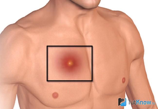 Графическое изображение абсцесса в районе грудной мышцы