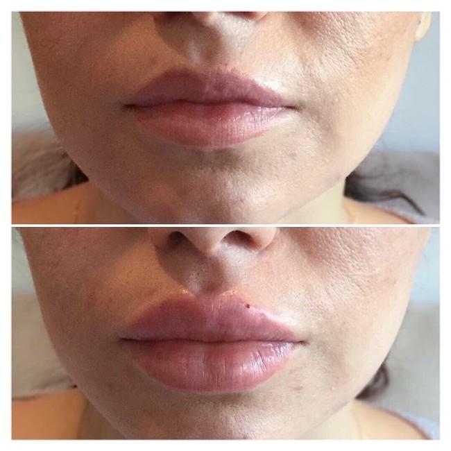 До и после увеличения губ биогелем