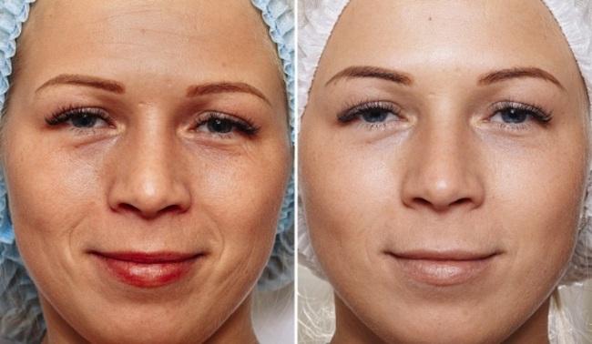 Лицо до и после микродермабразии