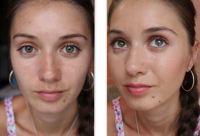 Кожа лица до и после микродермабразии