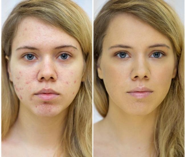 До и после фототерапии лица