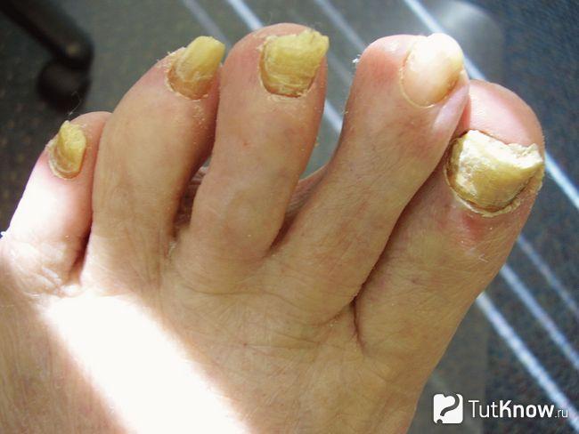 Затвердевшие ногти на ноге пожилого человека