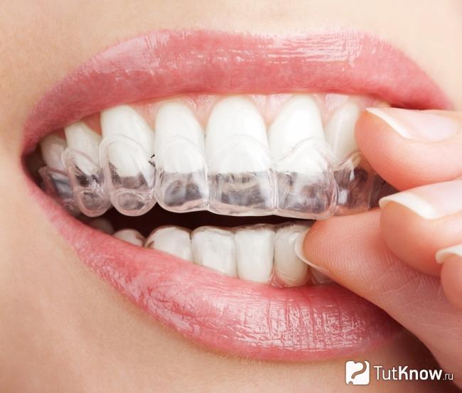 Капа для отбеливания зубов противопоказания thumbnail