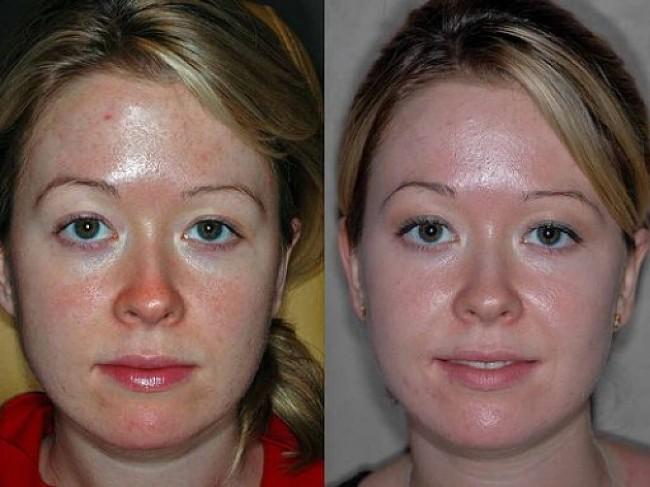 До и после механической чистки лица