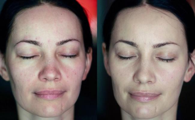 Кожа лица до и после механической чистки