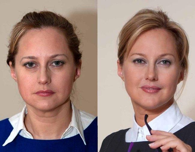 Фото до и после коррекции носослезной борозды