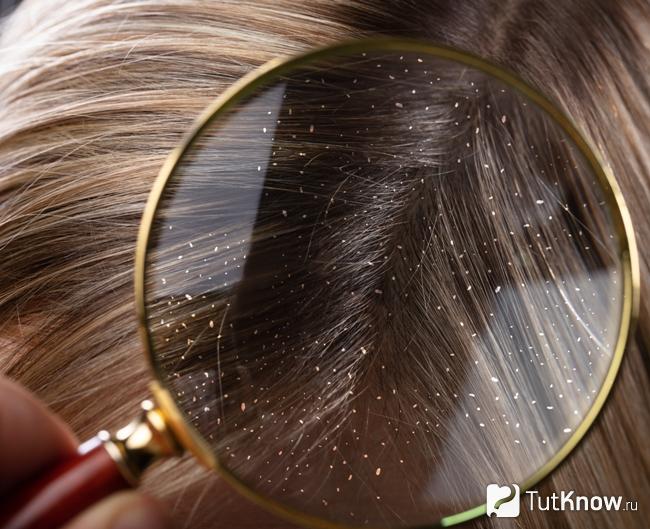 Себорея как противопоказание к осветлениб волос лимоном
