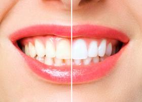 Почему темнеют зубы и что делать