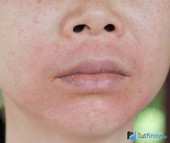 Аллергия на термальную воду для лица