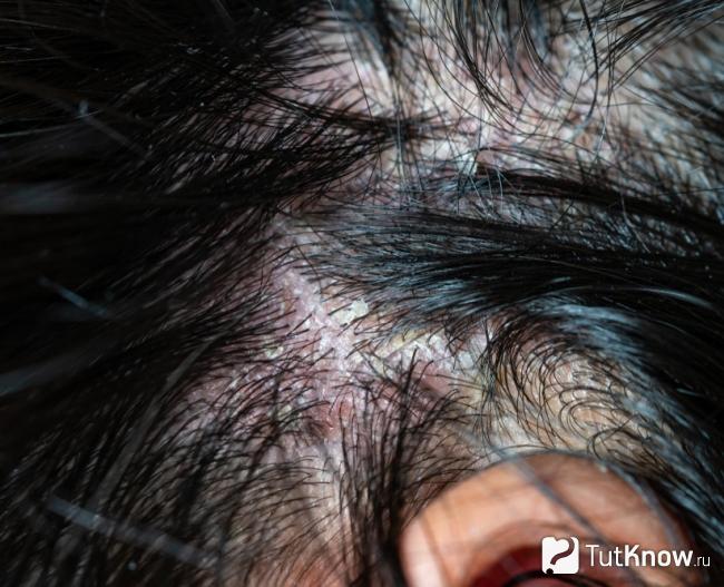 Дерматит на голове как противопоказание к применению мезороллера для волос