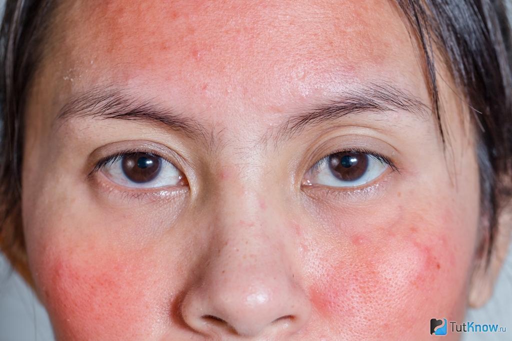 Аллергия на лице красные пятна у ребенка фото