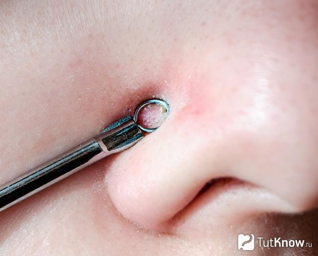 Механическая чистка для удаления черных точек