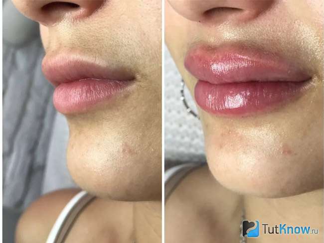 Как ухаживать за губами после увеличения филлером
