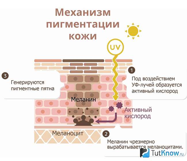 Причины появления пигментных пятен